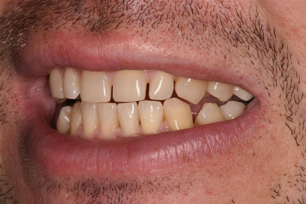 JD smiling with uneven, crooked, and gapped teeth