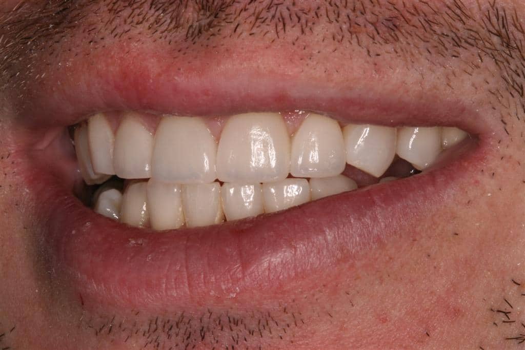 JD's teeth with veneers, showing straight teeth without any gaps