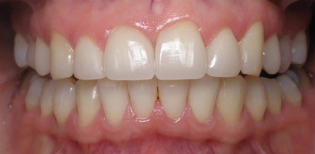 Marie smiling with white, beautiful straight teeth with veneers