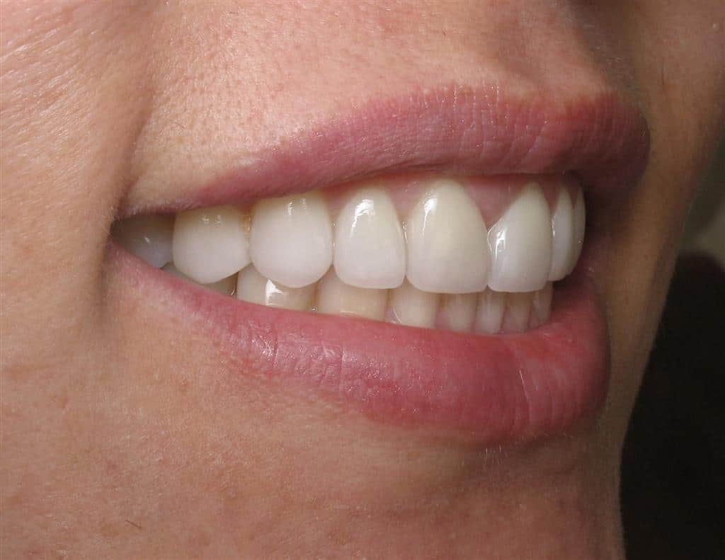 Steph smiling with a full set of white, straight teeth after veneers