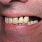 Anthony smiling with many infected and lost teeth