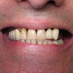 Anthony smiling with many infected and lost teeth