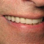 Anthony smiling with a full set of teeth after Dr. Kim placed implants and a secure fixture in