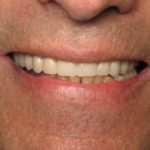 Anthony smiling with a full set of teeth after Dr. Kim placed implants and a secure fixture in