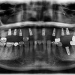 An x-ray showing four screws in place of dental implants in the mouth