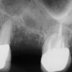 A dental x-ray of two teeth