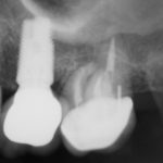 A dental x-ray of teeth with a dental implant in one tooth