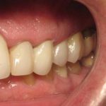 Charles with a full set of teeth after having a dental implant