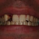 Corey smiling with a missing front tooth after having an accident