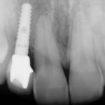 An x-ray showing a dental implant screw in place in the upper jaw