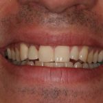 Corey smiling with a full set of teeth after having a dental implant put in