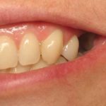 Erin smiling with a missing tooth