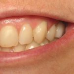 Erin smiling with a full set of teeth after having a dental implant