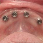 Four implants in a gumline