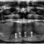An x-ray showing four screws in place of dental implants in the mouth
