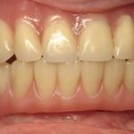 Gloria's smile with a full set of straight teeth after having four implants