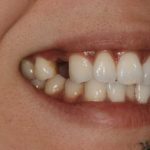 Peggy smiling with a tooth missing after having broken it