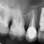 An x-ray showing a dental implant screw in place