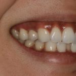 Peggy smiling with straight teeth after having a dental implant put in