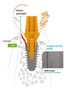 An illustration of how the Anyridge Implant System works including various post height, hermetic sealing, and cuff height