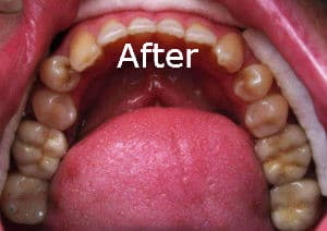 An after-photo of one of Dr. Kim's patients with new tooth colored fillings