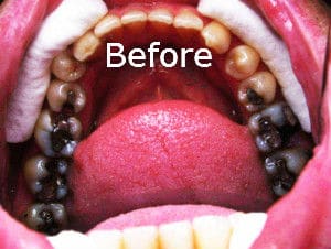 A before-photo of one of Dr. Kim's patients with decayed teeth and silver fillings