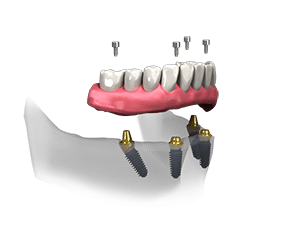 An all-on-four drawing showing four screws going into the bottom jaw of a set of teeth into four abutments