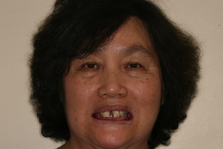 Chongrae smiling with uneven and missing teeth before having all-on-four implants