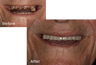 Before-and-after comparison of Ronald's teeth after having all-on-four dental implants by Dr. Kim at Pacific Smiles