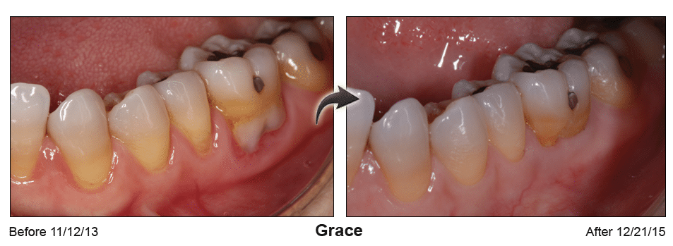 Pinhole Surgery before-and-after comparison of Grace's gum recession, performed by Dr. Kim at Pacific Smiles