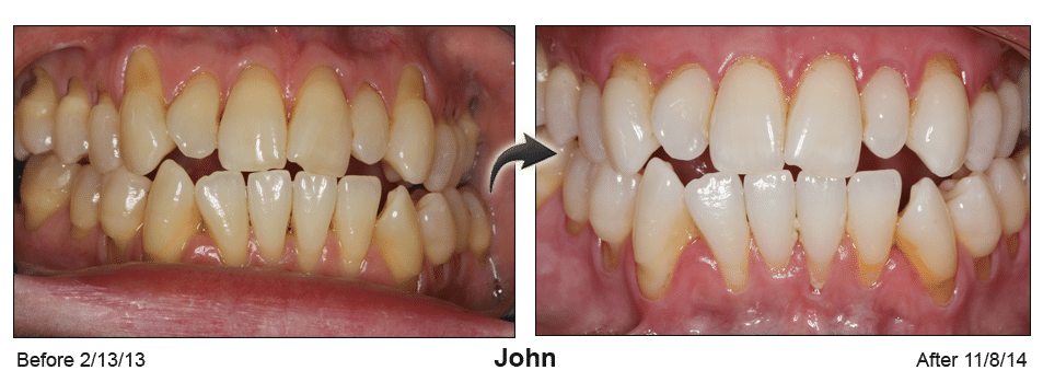 Pinhole Surgery before-and-after comparison of John's gum recession, performed by Dr. Kim at Pacific Smiles