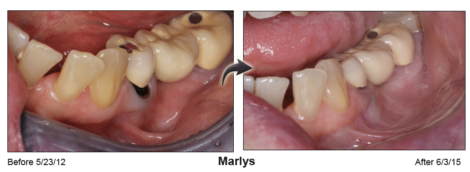 Pinhole Surgery before-and-after comparison of Marlys' gum recession, performed by Dr. Kim at Pacific Smiles