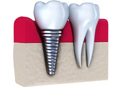An illustration of a dental implant screwed into the gums next to a natural tooth