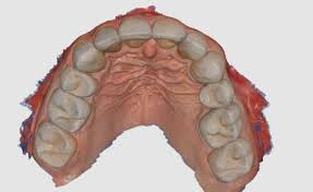 A Digital Impression taken of teeth
