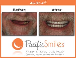 A Before and After All On Four case by Dr. Kim, DDS, FAGD at Pacific Smiles