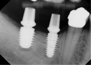 Dental Implant - Redondo Beach - Image 3