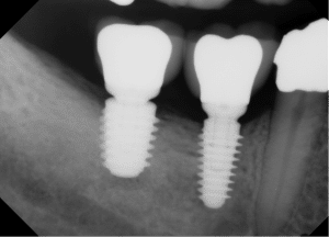 Dental Implant - Redondo Beach - Image 4
