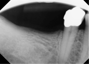 Dental Implant - Redondo Beach - Image 1